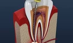 Root Canal in Visakhapatnam