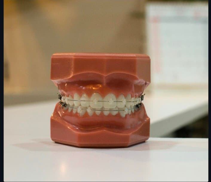 Aligners Treatment in Visakhapatnam